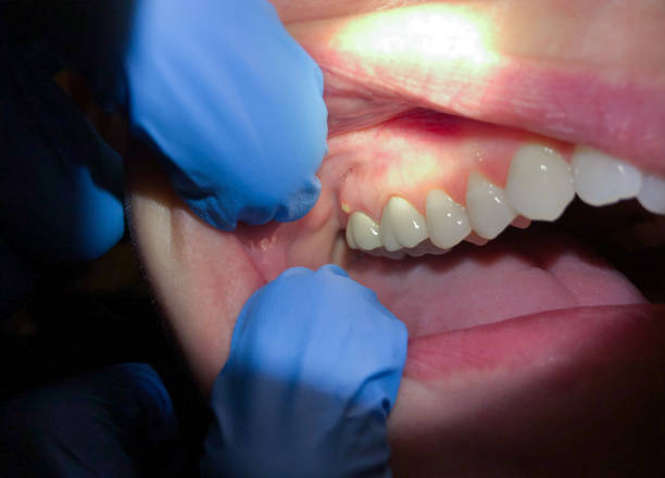 Best Knocked-Out Tooth Emergency  in Lakewood Ranch, FL